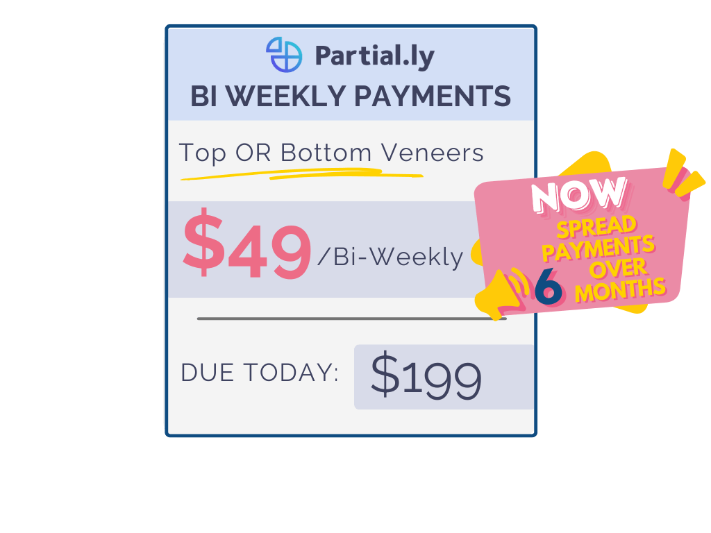 Bi-Weekly Payment Plan - Poponveneers with At Home Impression Kit