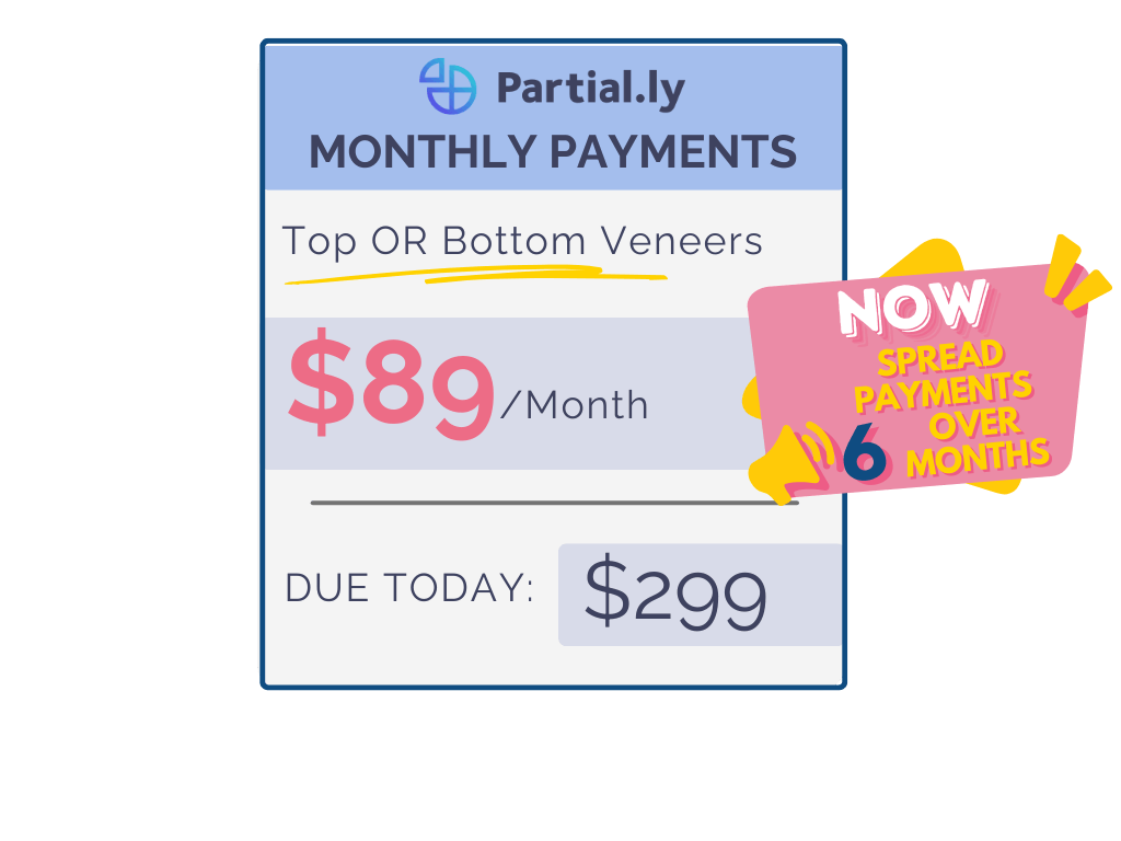 Monthly Payment Plan - Poponveneers with At Home Impression Kit
