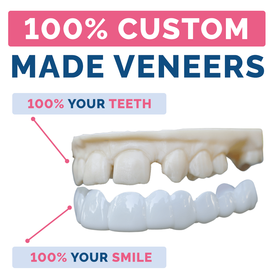Weekly Payment Plan - Poponveneers with At Home Impression Kit
